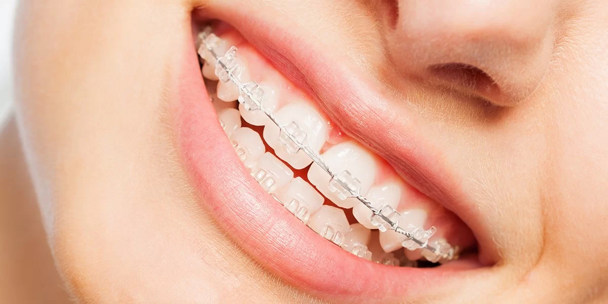 Park Street Dental | Quick Straight Teeth Treatment
